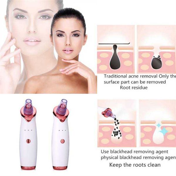 Remove Acne Instrument 【Fast Delivery】Blackhead Remover Instrument Black Dot Remover Acne ...